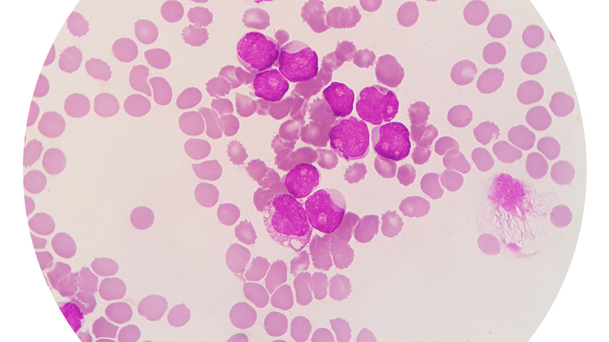 Neue AML-Therapie mit Lymphotoxin Alpha entwickelt